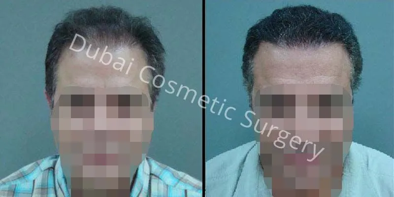 32388 glutathione injection