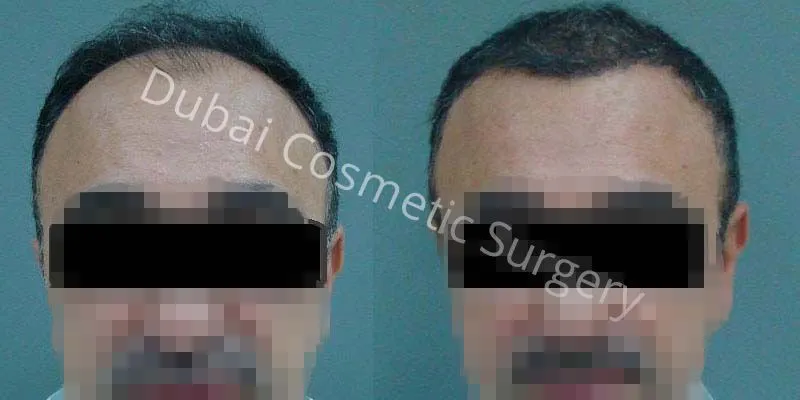 32388 vitamin c injection