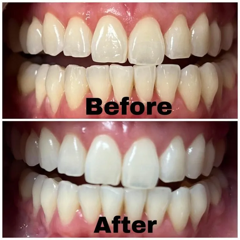 32390 at home teeth whitening