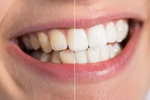 32392 teeth whitening aurora co professional