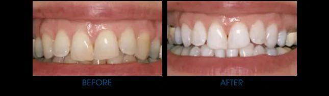 32409 lumibrite teeth whitening before after