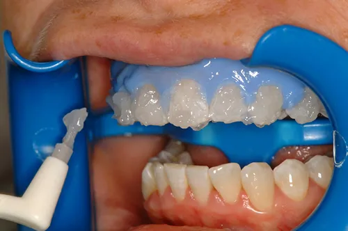 32409 lumibrite teeth whitening smile