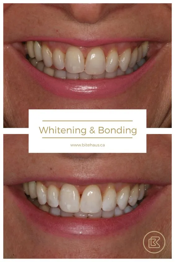 32415 oxydent teeth whitening before after