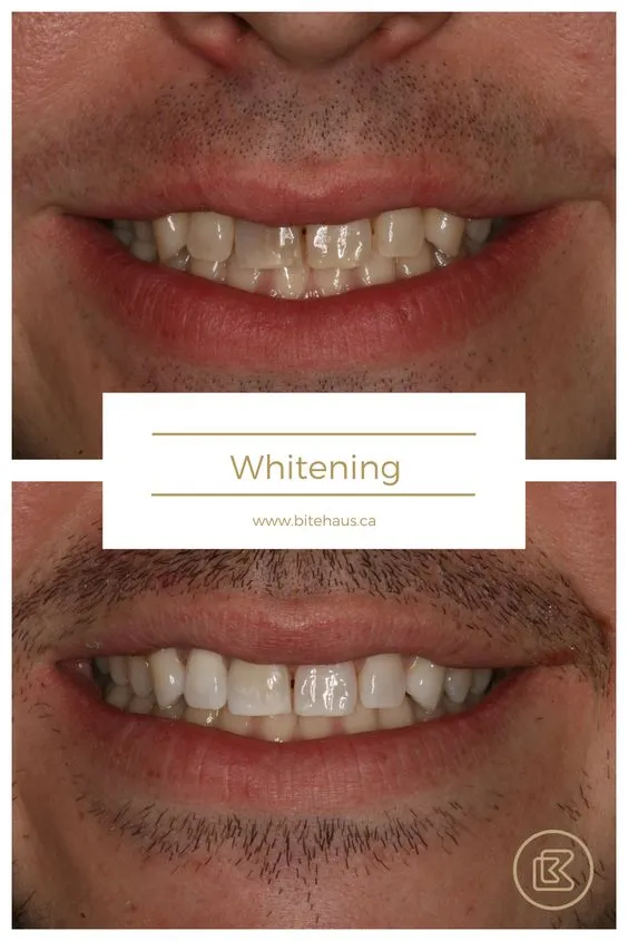 32415 oxydent teeth whitening products