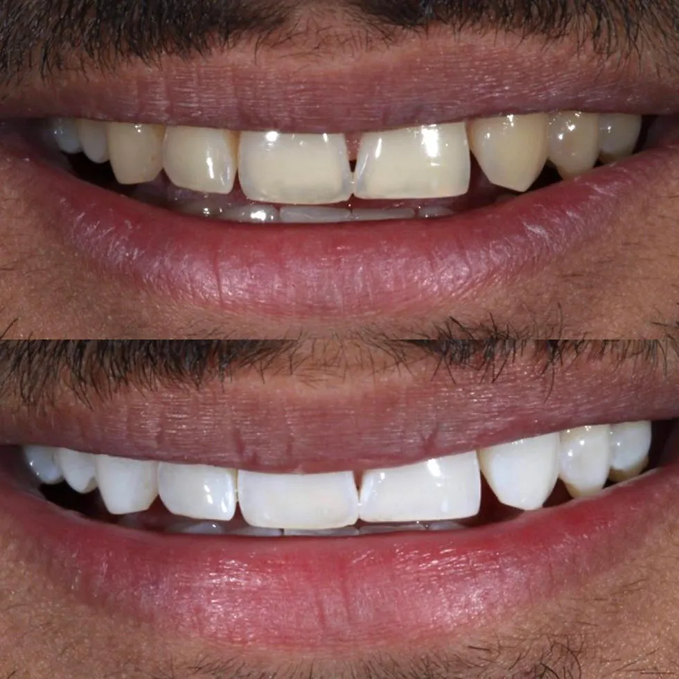 32415 teeth whitening application