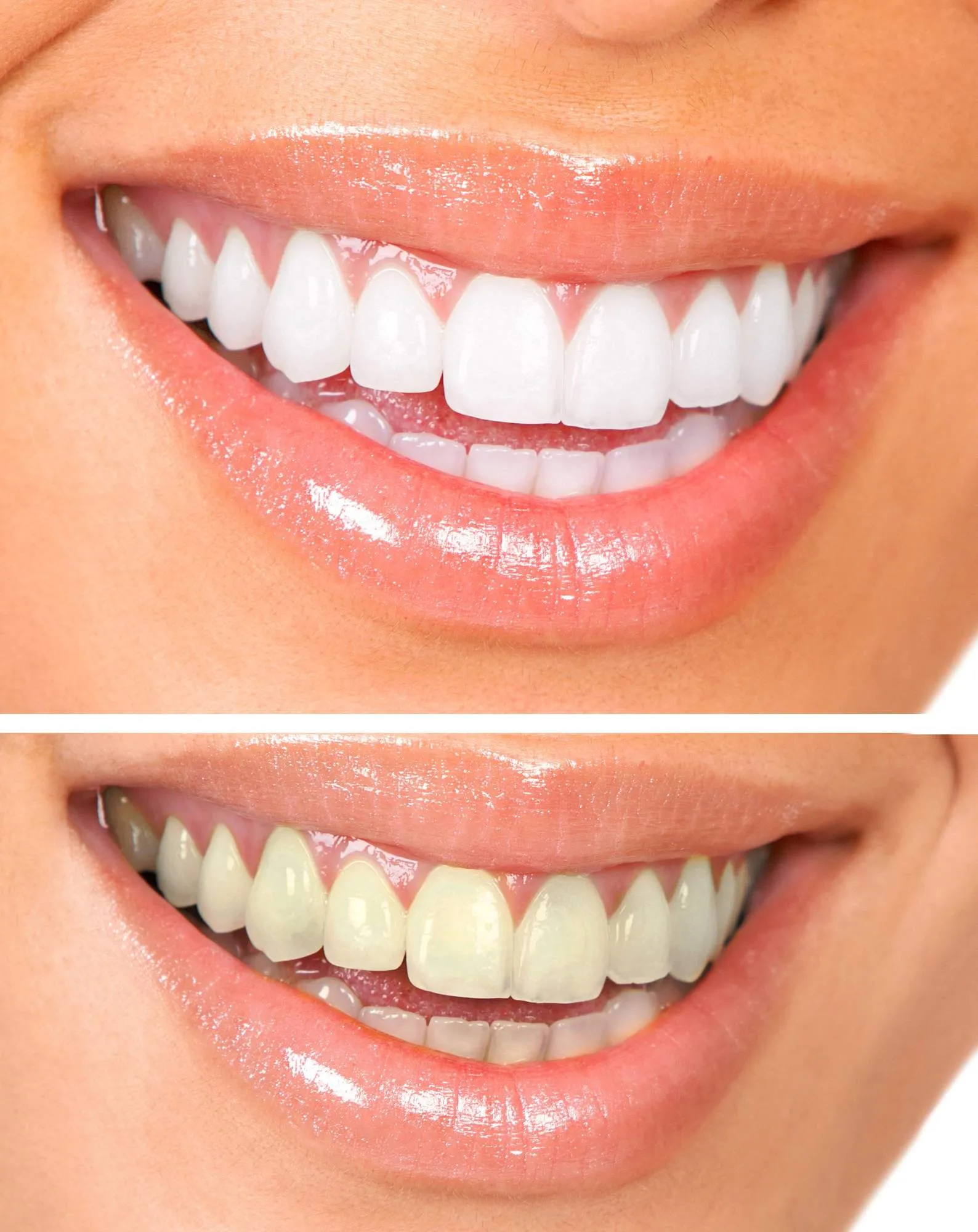 /img/32415-teeth-whitening-comparison.webp