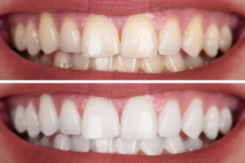 32419 professional teeth whitening