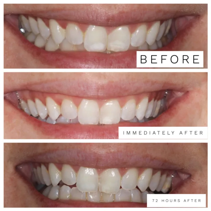 32422 impact braces teeth whitening