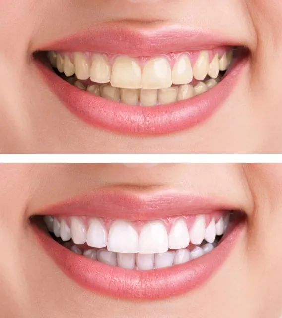 32422 types whitening strips