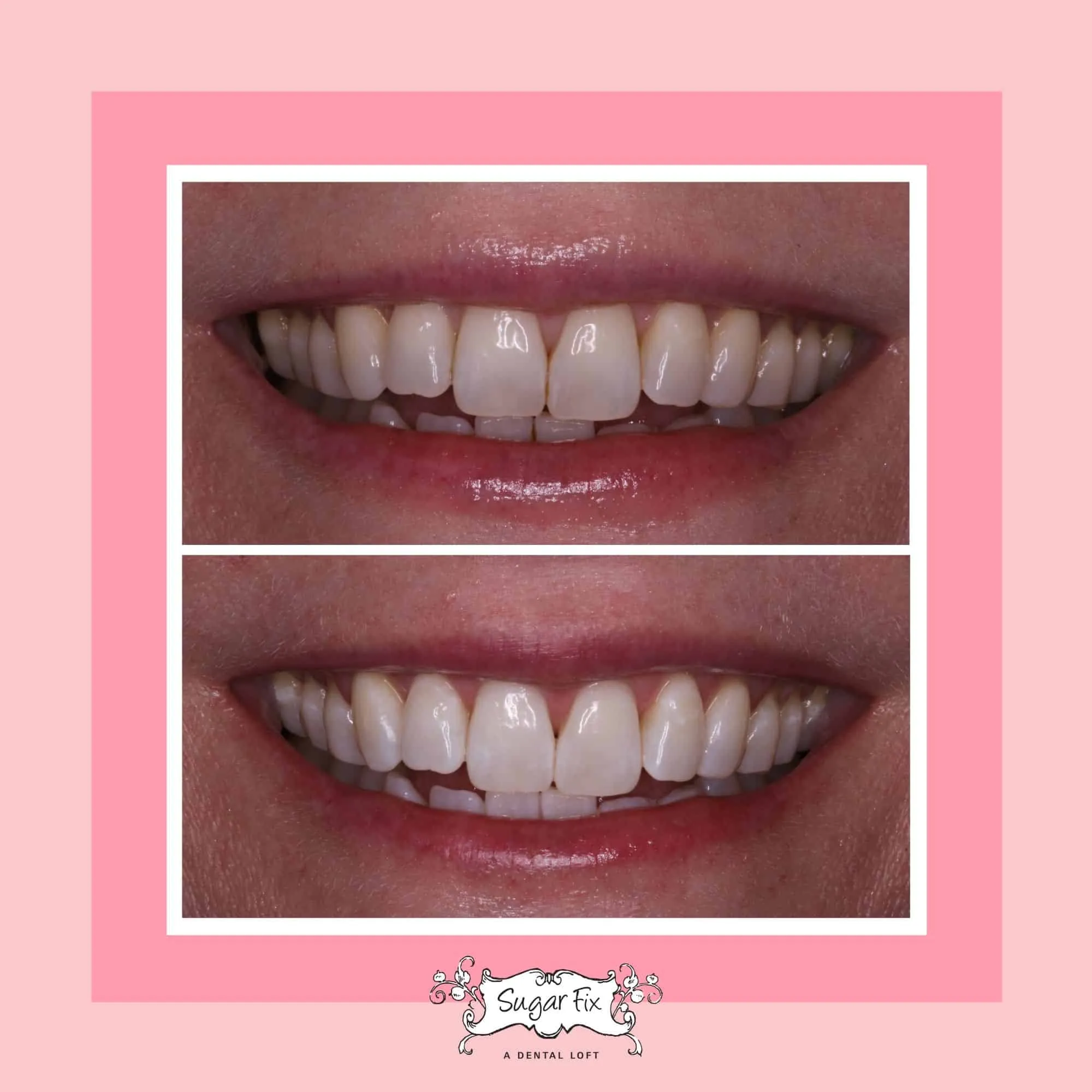 32424 teeth whitening winchester at home kits