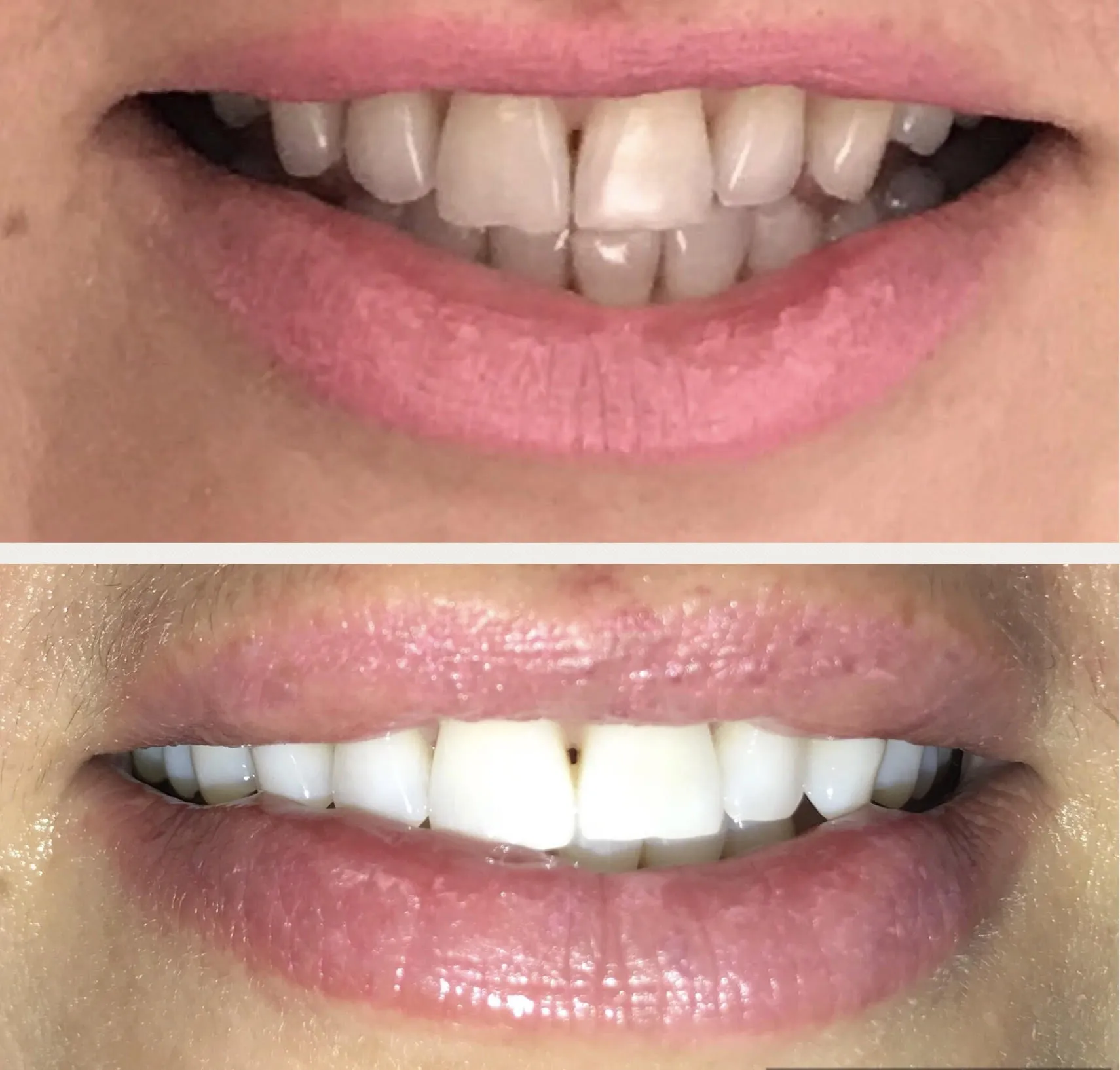 32424 teeth whitening winchester oral hygiene