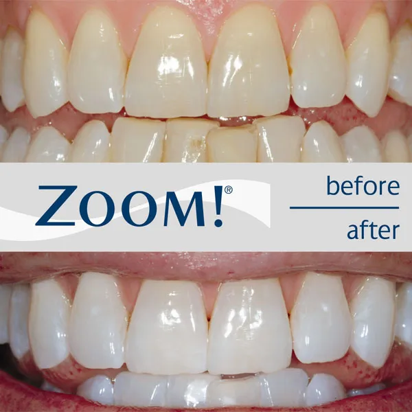 32424 teeth whitening winchester types