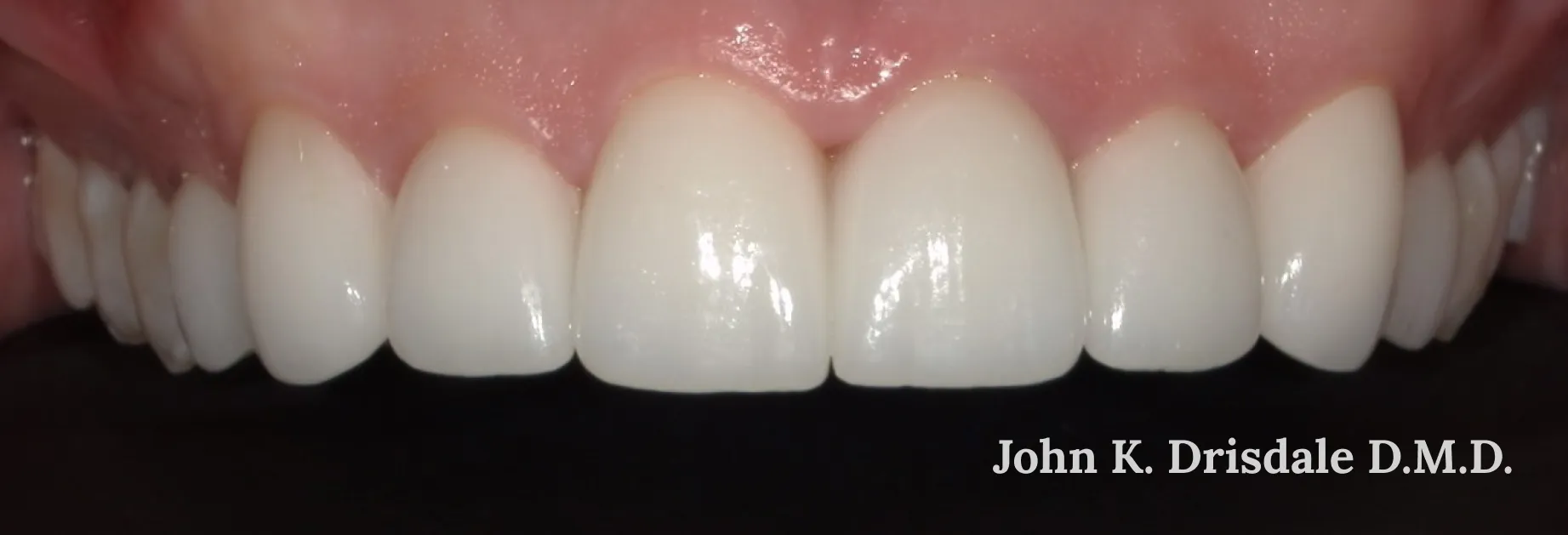 32425 teeth whitening midland tx 2