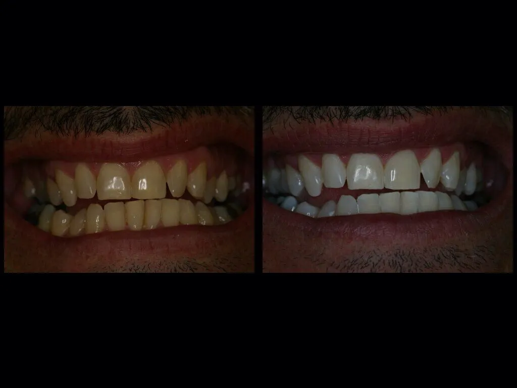 32428 zoom whitening aftercare 1