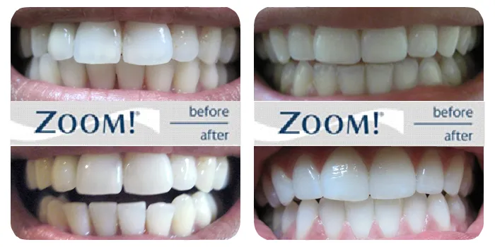 32428 zoom whitening aftercare 6