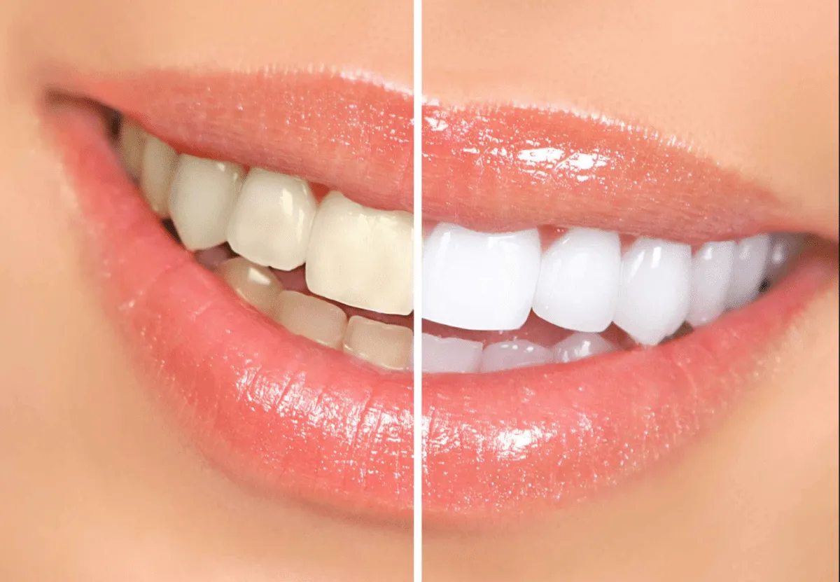 32434 bleach please teeth whitening smile