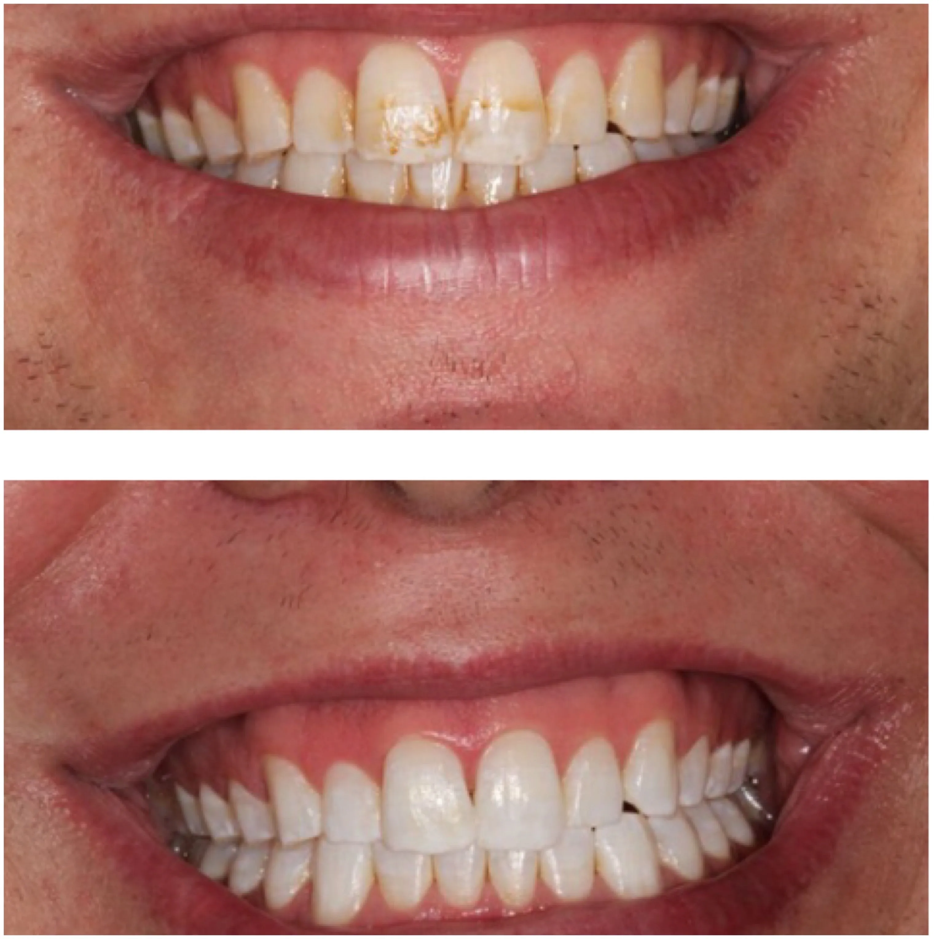 32442 teeth whitening overview