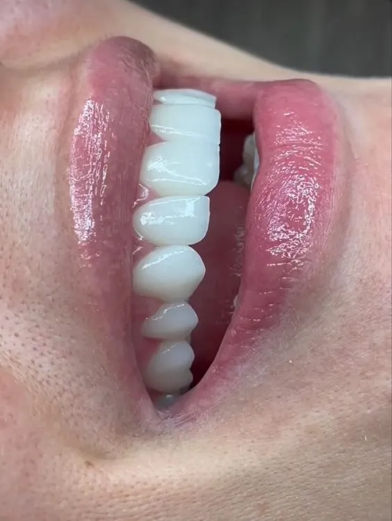 32444 cleaning teeth before whitening