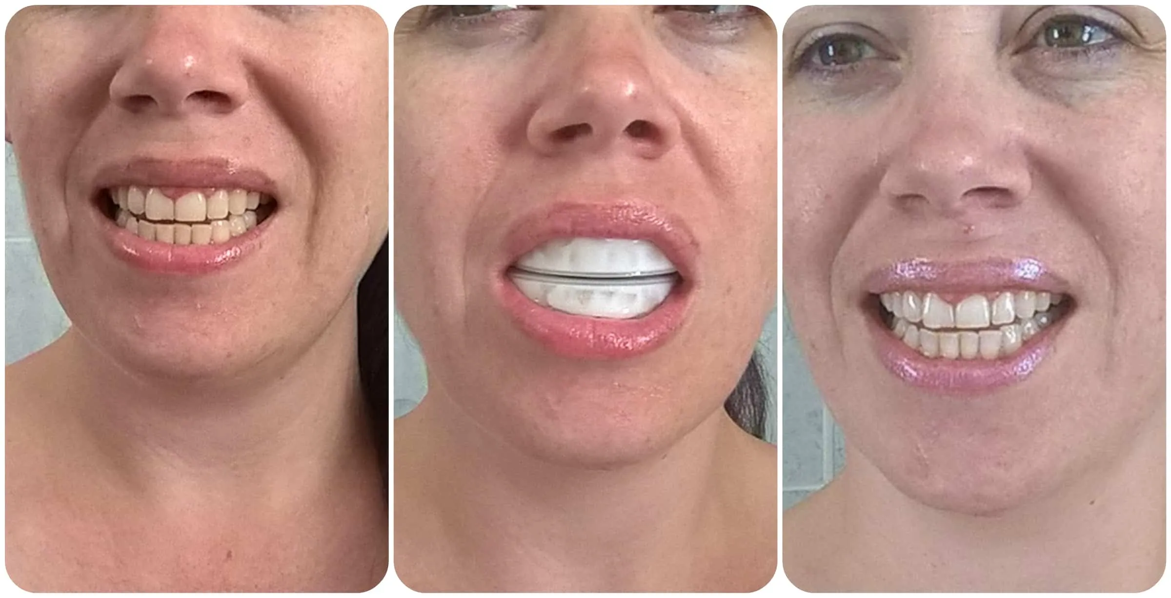 32444 teeth whitening results