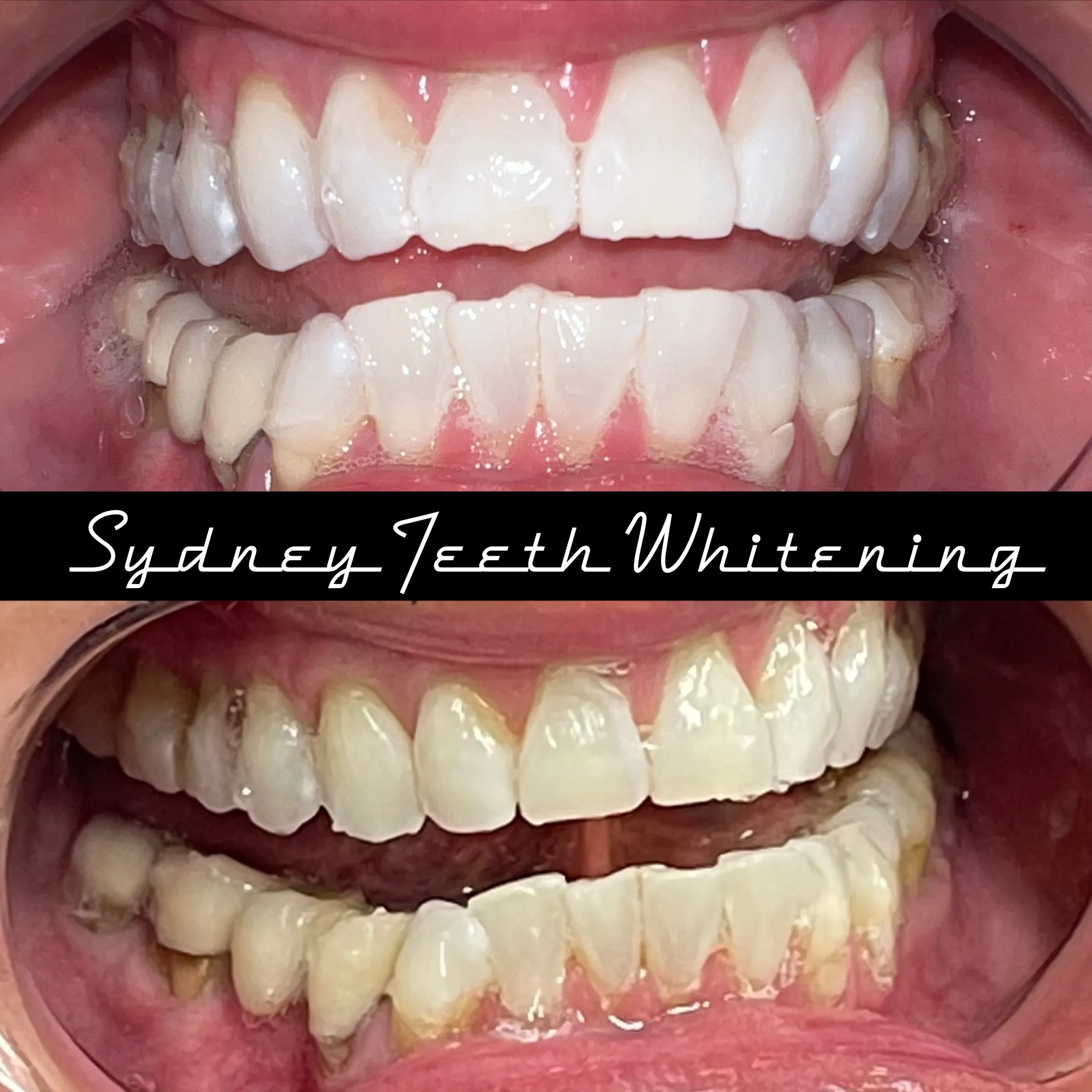 32446 teeth whitening process