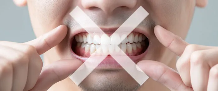 32448 at home teeth whitening