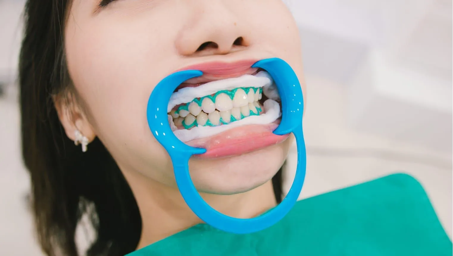 32449 teeth stains image5