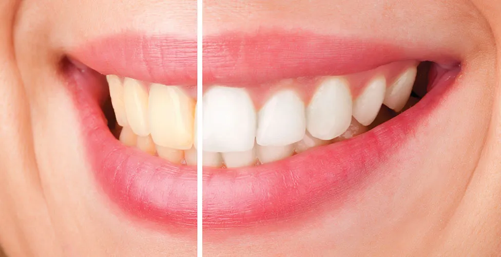 32452 teeth whitening treatment