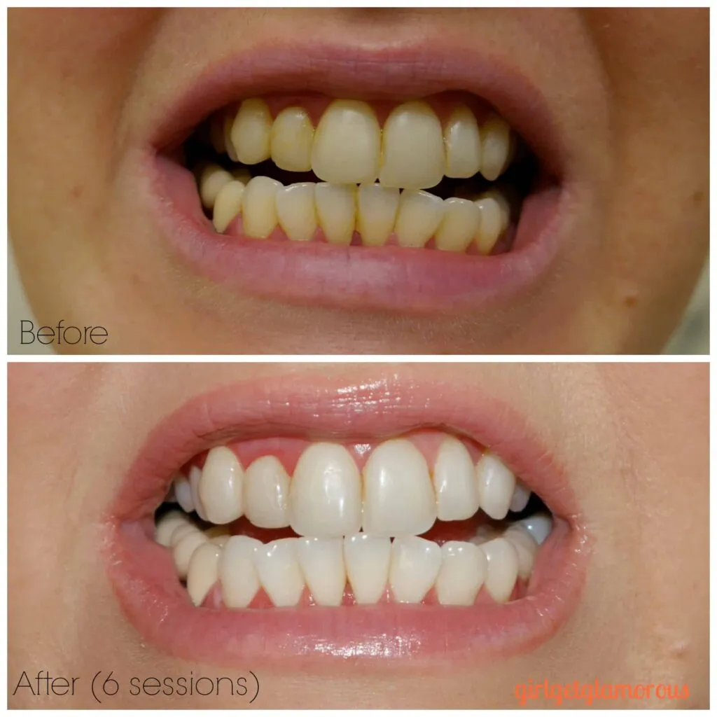 32453 applying whitening gel