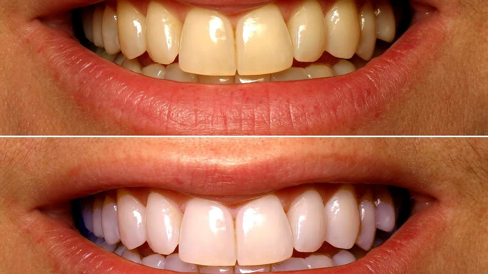 32453 cleaning whitening trays