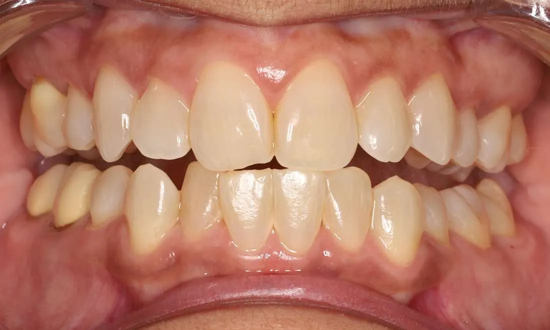 32453 whitening trays before after