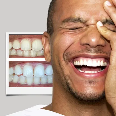 32462 teeth whitening results