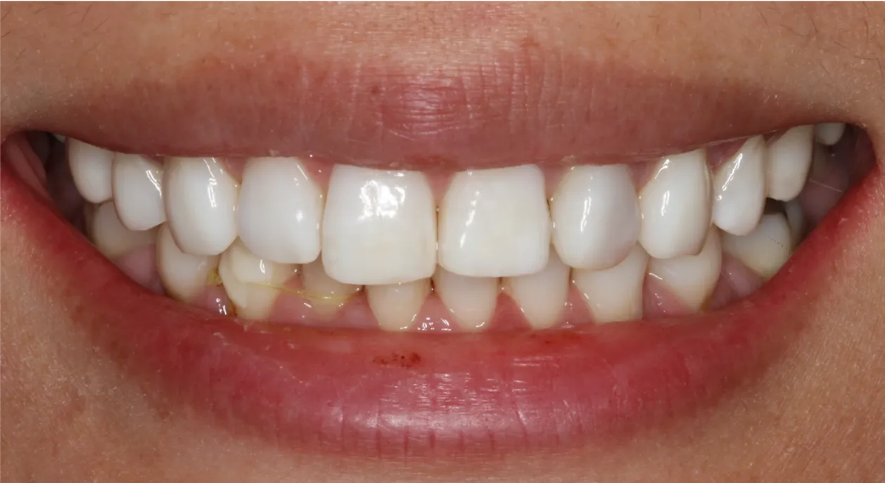 32463 uneven whitening