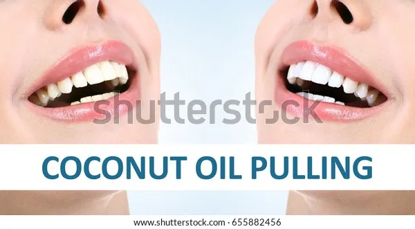 32470 teeth whitening