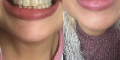 /img/32477-teeth-whitening-results.webp