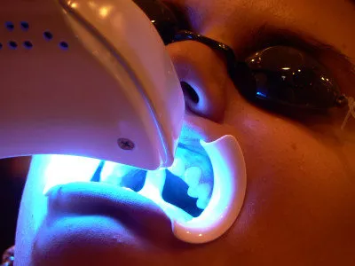 32491 professional teeth whitening