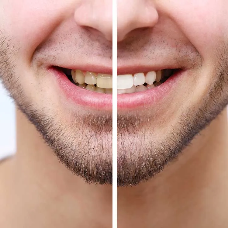 32491 take home whitening kit