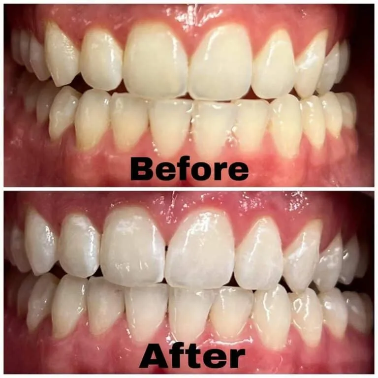 32492 teeth whitening orange county ca maintain