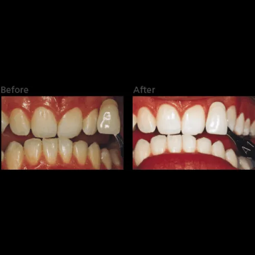 32499 long lasting results teeth whitening