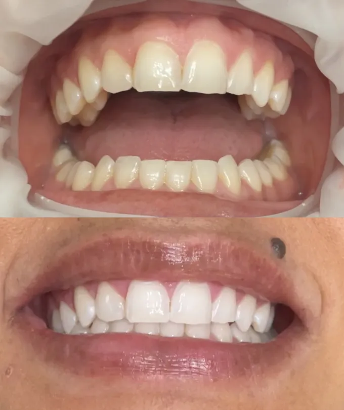 32506 before after teeth whitening