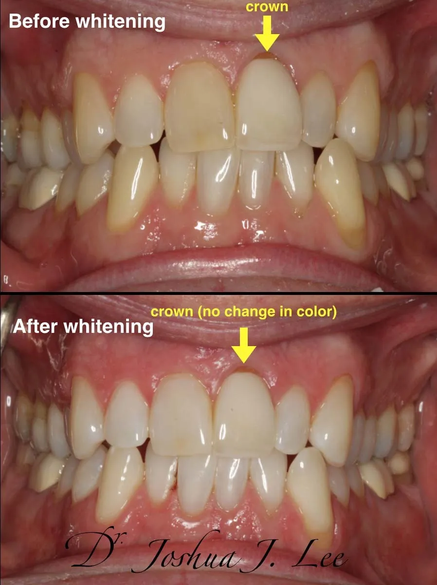 32511 teeth whitening maintenance