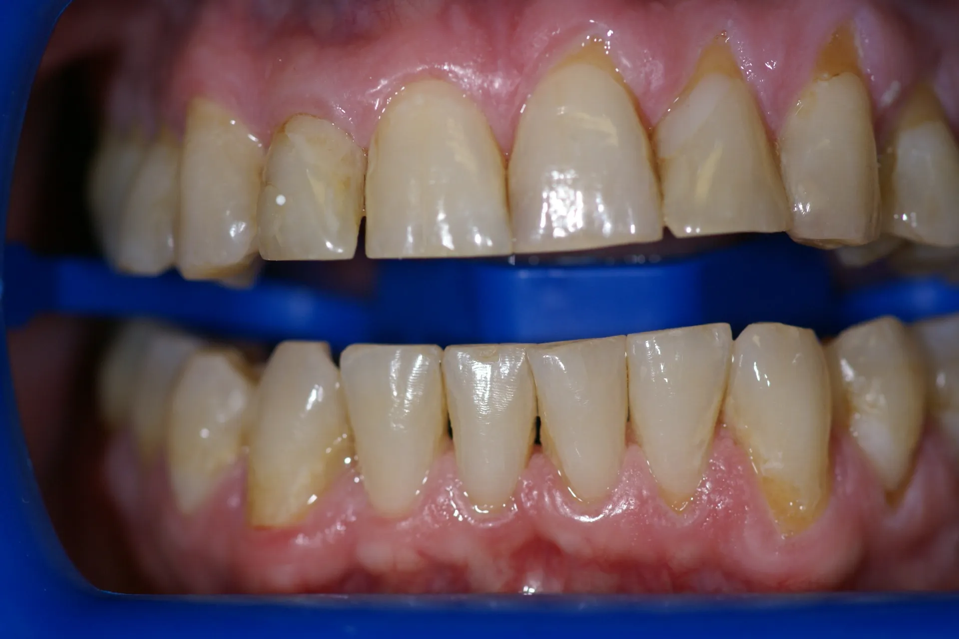 32511 zoom whitening sensitivity