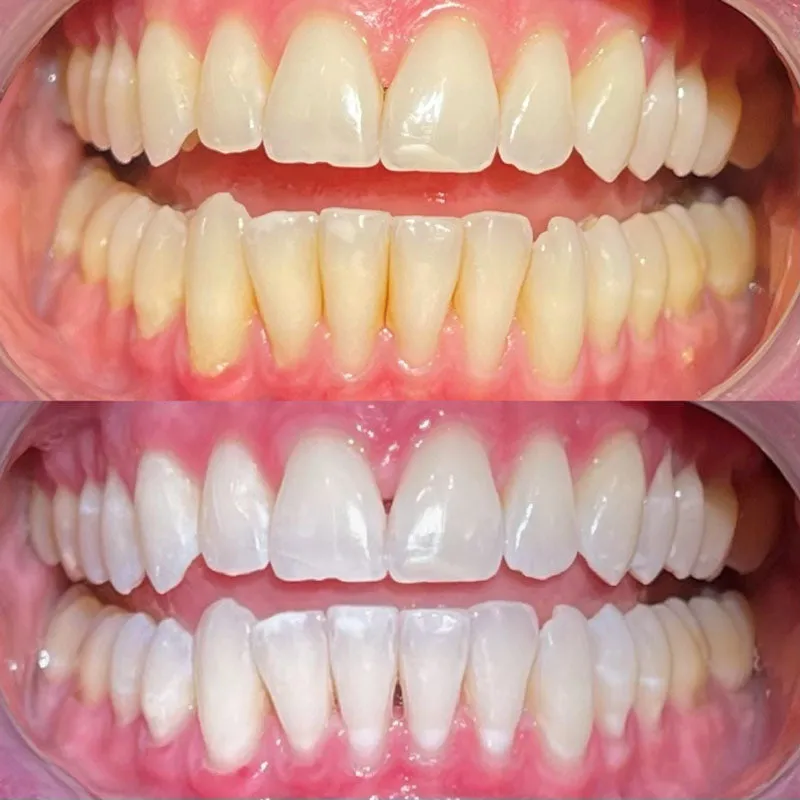 32518 mr blanc teeth whitening before after