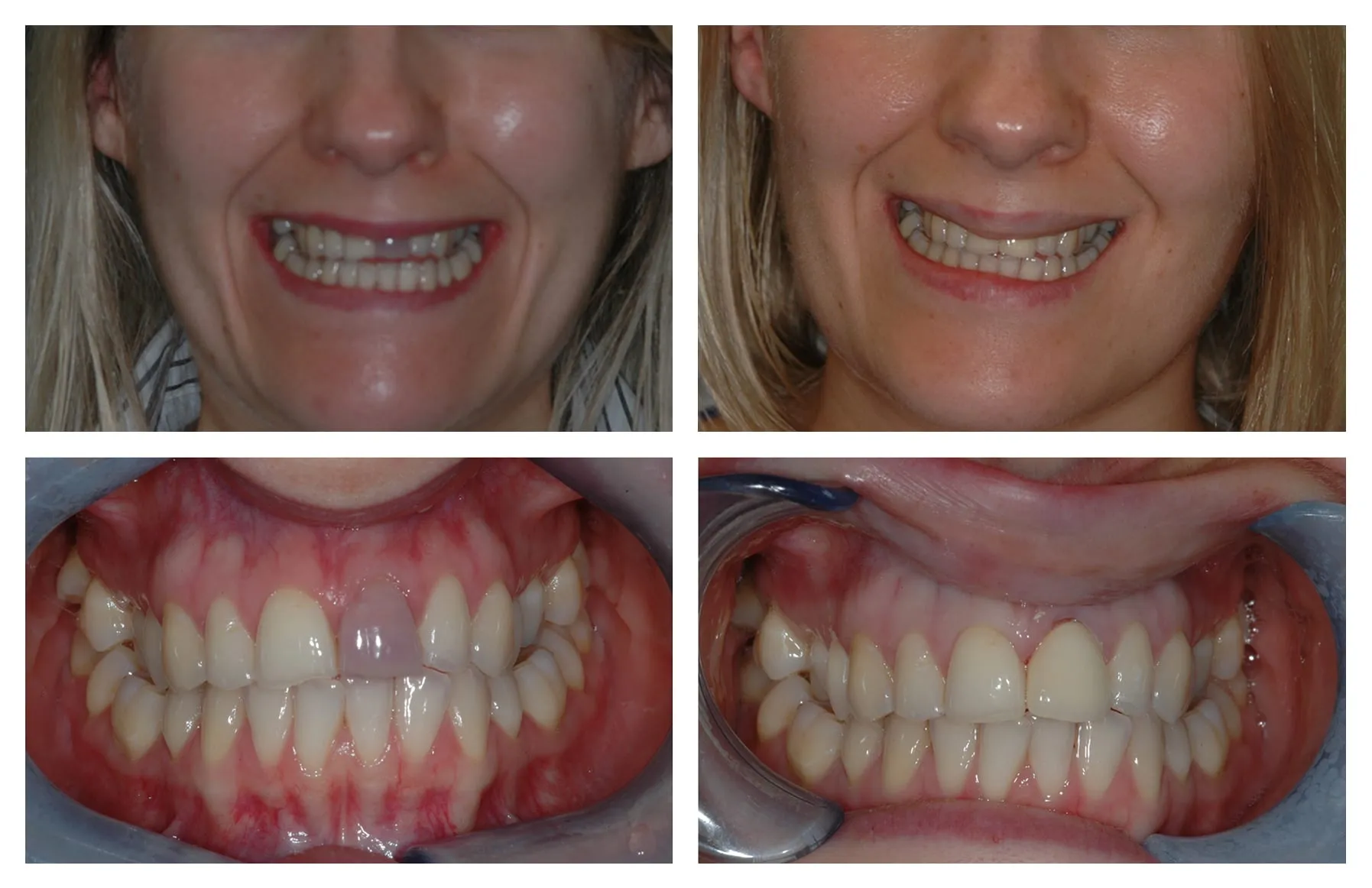 32520 over the counter teeth whitening