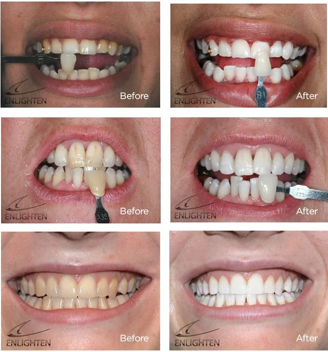 32520 teeth whitening maintenance