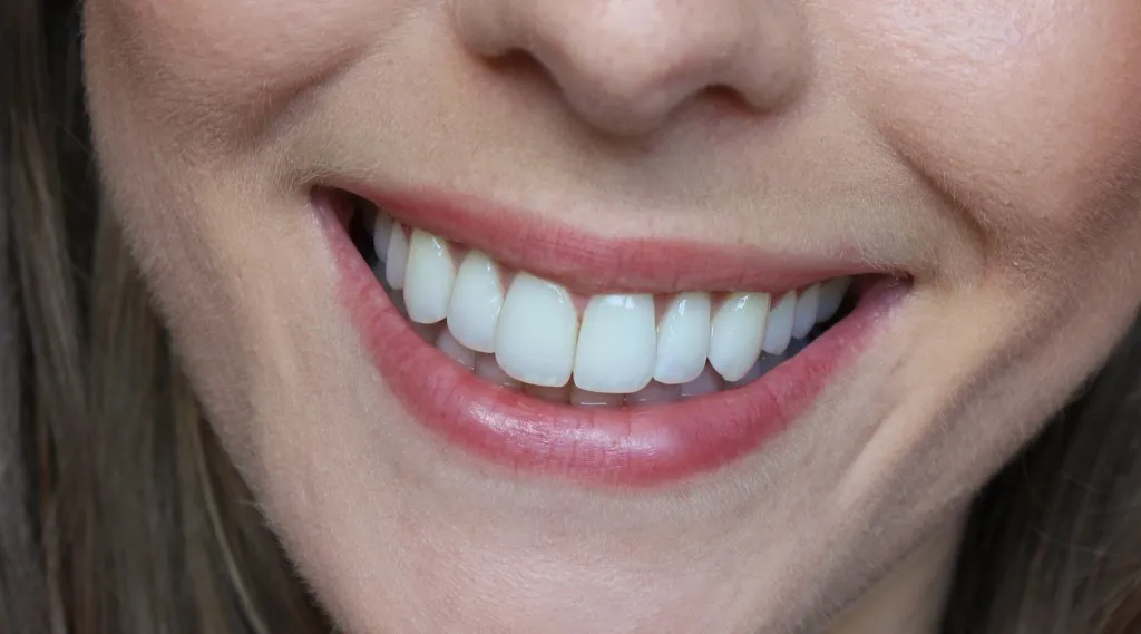 32521 whitening strips before after