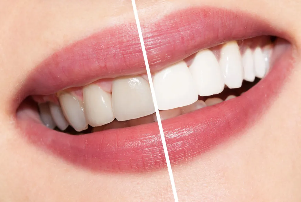 32523 teeth whitening process