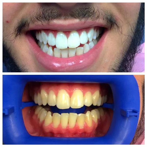 32526 teeth whitening cost