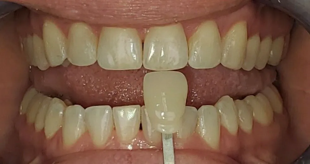 32526 teeth whitening options