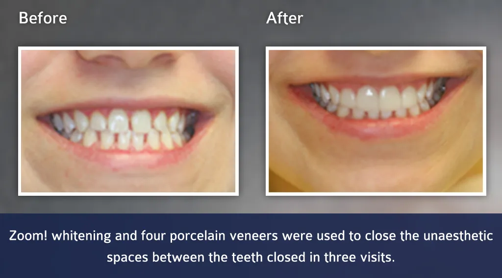 32531 whitening veneers before after
