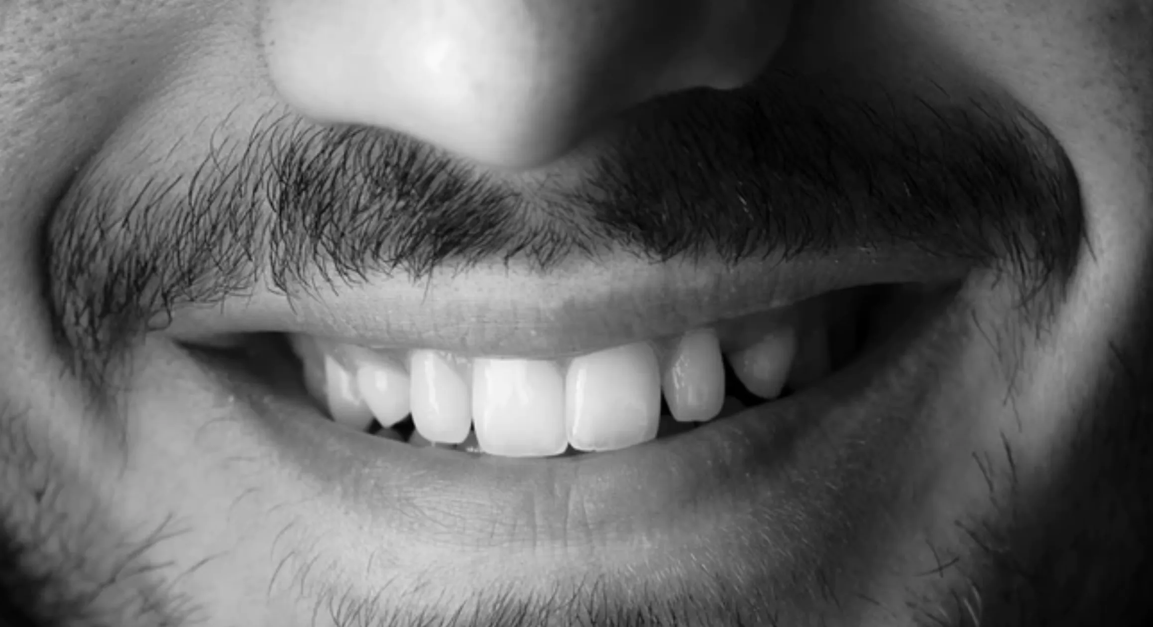 32531 whitening veneers durability